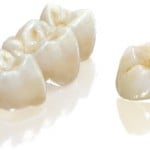 Dental Crowns