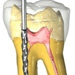 Root Canal Therapy