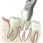 Tooth Extractions